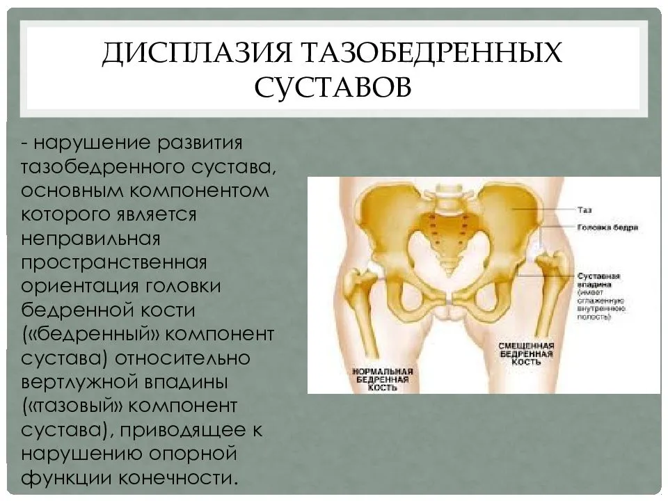 Дисплазия тазобедренных суставов у детей:  симптомы, причины развития, лечение дисплазии тбс, массаж и гимнастика при дисплазии тазобедренных суставов  