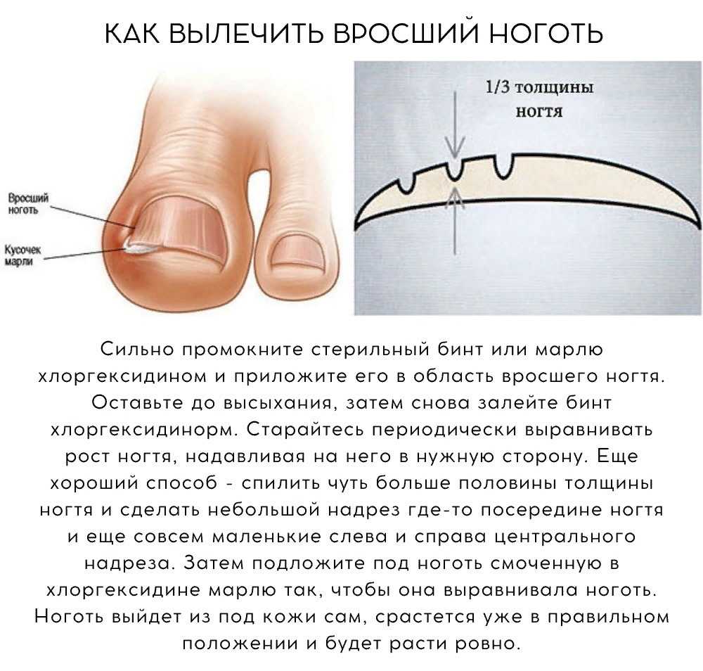 Вросший ноготь у кошки: что делать, как проходит лечение, если вросли ногти в подушечки - блог о животных - zoo-pet.ru