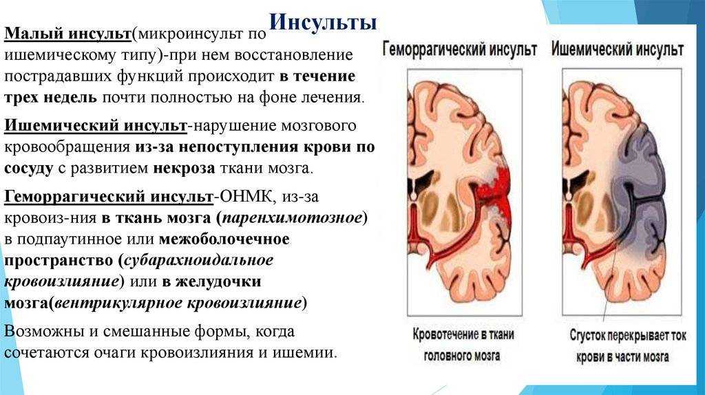 Инсульт у кошек: симптомы и лечение