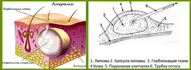Жировик у кота что делать. липома: признаки и лечение жировиков у кошки. особенности лечения жировика у домашнего животного