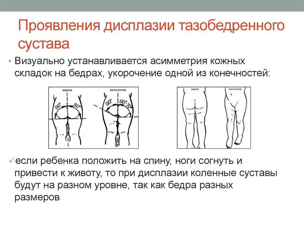 Дисплазия тазобедренных суставов у новорожденных детей: что это такое, лечение и признаки у грудничков