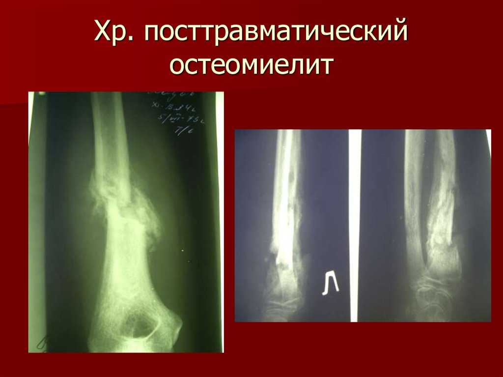 Лечение остеомиелита челюсти у кошек