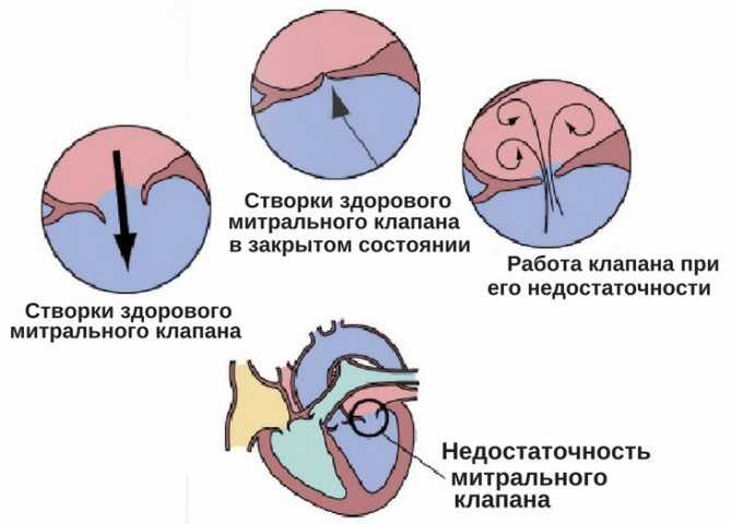 Эндокардиоз атриовентрикулярных клапанов у собак
