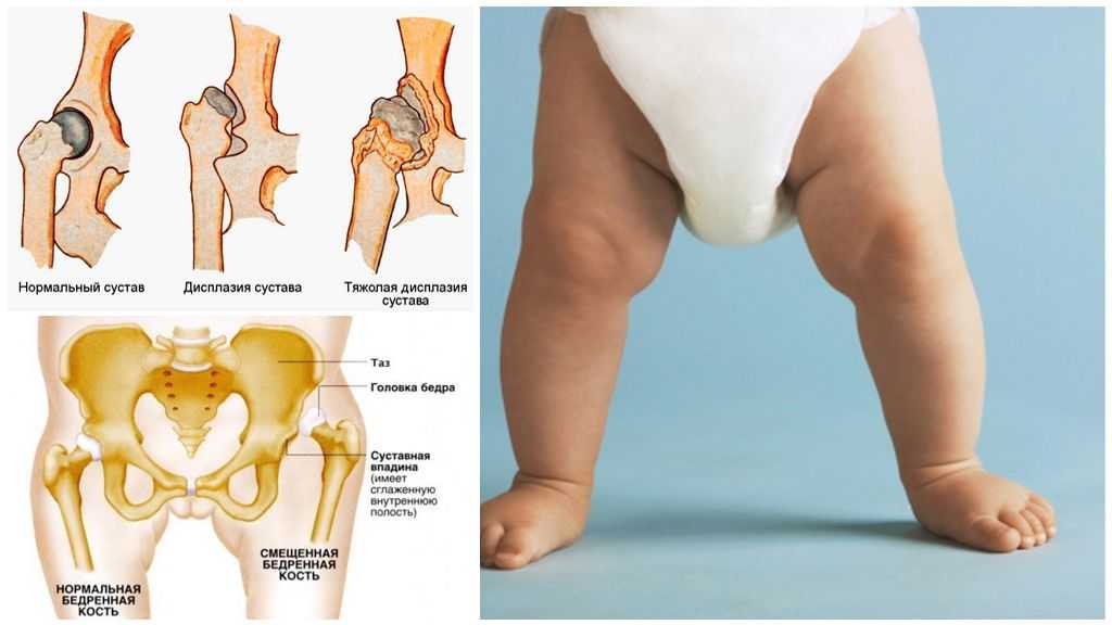 Дисплазия тазобедренного сустава ortoped-klinik.com