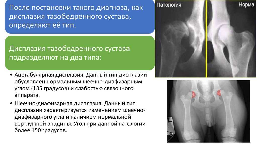Как понять, что у ребенка дисплазия тазобедренного сустава?