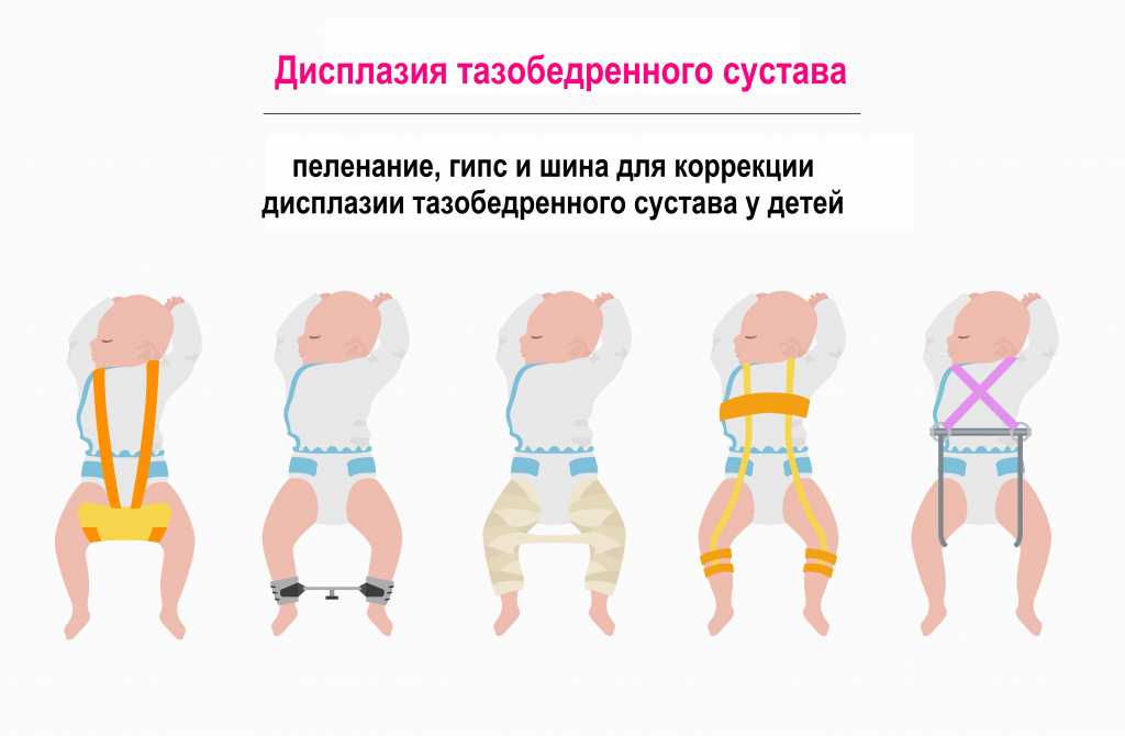 Дисплазия тазобедренного сустава у взрослых и детей: причины, диагностика, лечение, последствия