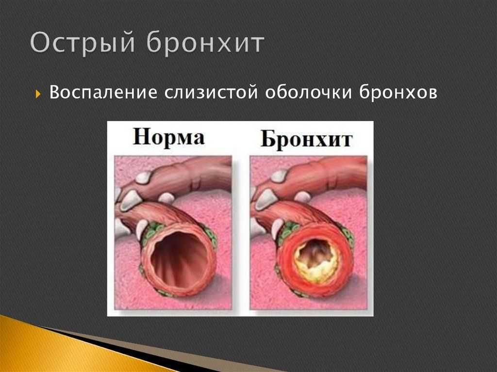 Влияет ли собака на хронический бронхит. астма у людей и домашних животных